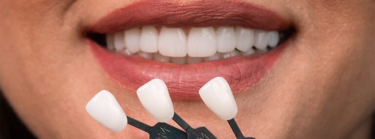 Descubre el Costo y Secretos de las Carillas Dentales – Información Exclusiva