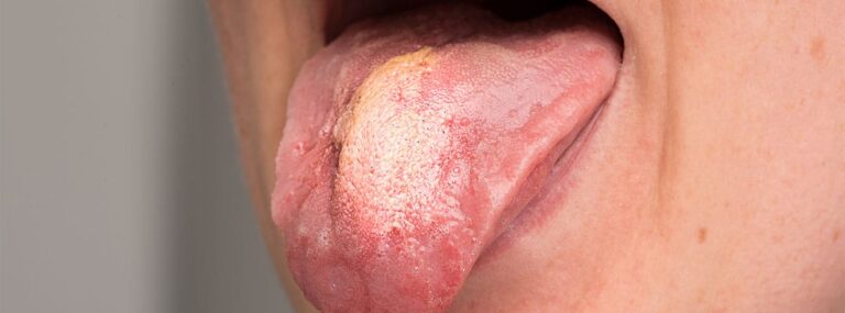 Descubre los secretos de las manchas en la boca – Guía de Salud MAPFRE