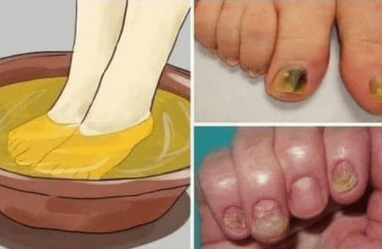 Elimina de raíz los hongos en tus uñas con estos poderosos remedios naturales – Guía Saludable