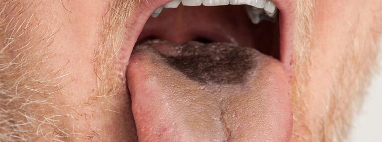 Misterioso fenómeno de la lengua oscura: causas y soluciones